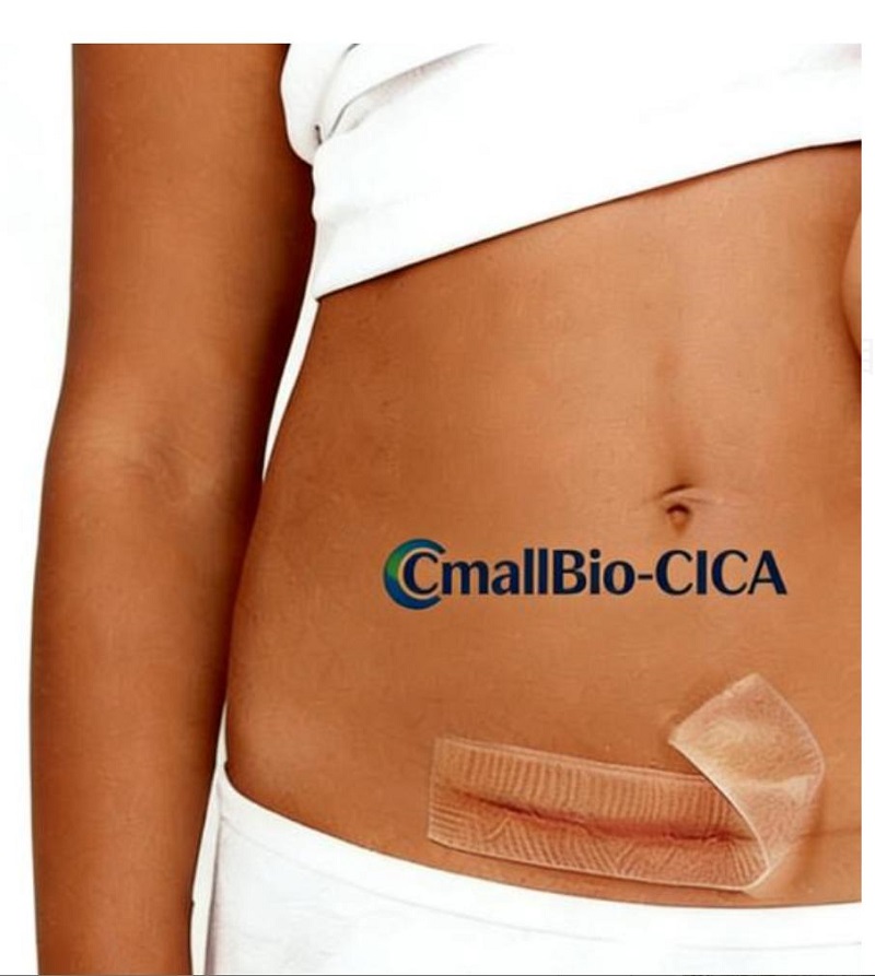 Scar Patch ใดที่ดีที่สุดสำหรับแผลเป็น Hypertrophic C-Section? คู่มือการซื้อแผ่นแปะแผลเป็นเกรดทางการแพทย์ปี 2026